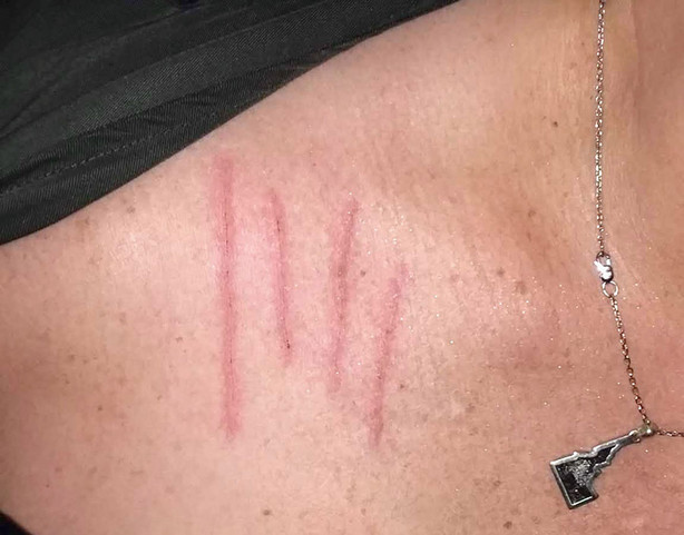 Unexplained scratches on Jennifer Erchuls neck.