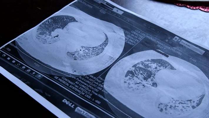 White marks on scans of Francisca Andujo’s lungs show significant scarring and inflammation.
