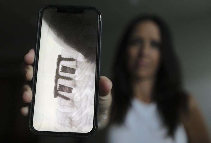 Angie Taylor shows an X-ray of where she had her neck
fused between C5, C6 and C7 with a cervical interbody device back
in March, while at her home in American Fork on Monday, Nov. 1.