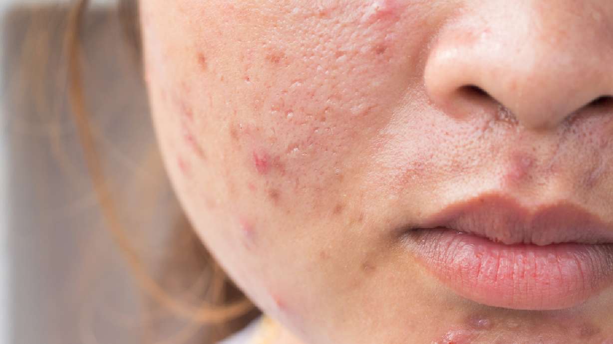 Doctors in Utah and elsewhere learning that healthy skin is critical to mental health