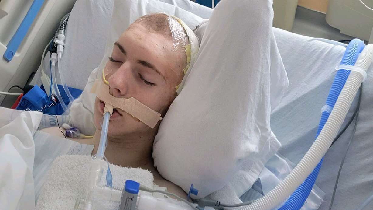 Hayden Hashagen had surgery on Feb. 28 at Primary Children’s Hospital in Salt Lake City. Hashagen, a sophomore at Ririe Junior-Senior High School, was fighting for his life after a sinus infection took a turn for the worse.