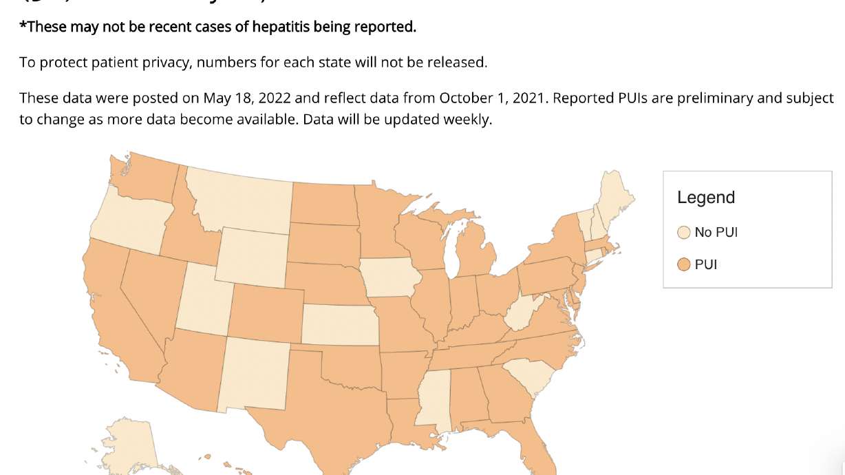 States with children under investigation for hepatitis up to May 18 are shown in a map. Health officials have identified two Utah children diagnosed with hepatitis "with no known cause" as part of a worldwide investigation that began in the U.S. last winter.