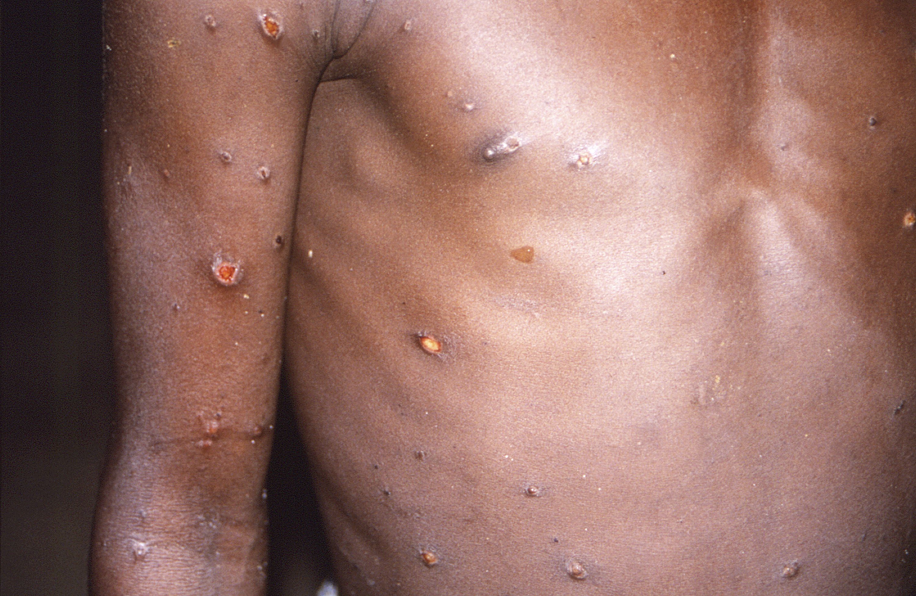 As health authorities in Europe and elsewhere roll out vaccines and drugs to stamp out the biggest monkeypox outbreak beyond Africa, in 2022, some doctors are acknowledging an ugly reality: The resources to slow the disease’s spread have long been available, just not to the Africans who have dealt with it for decades.