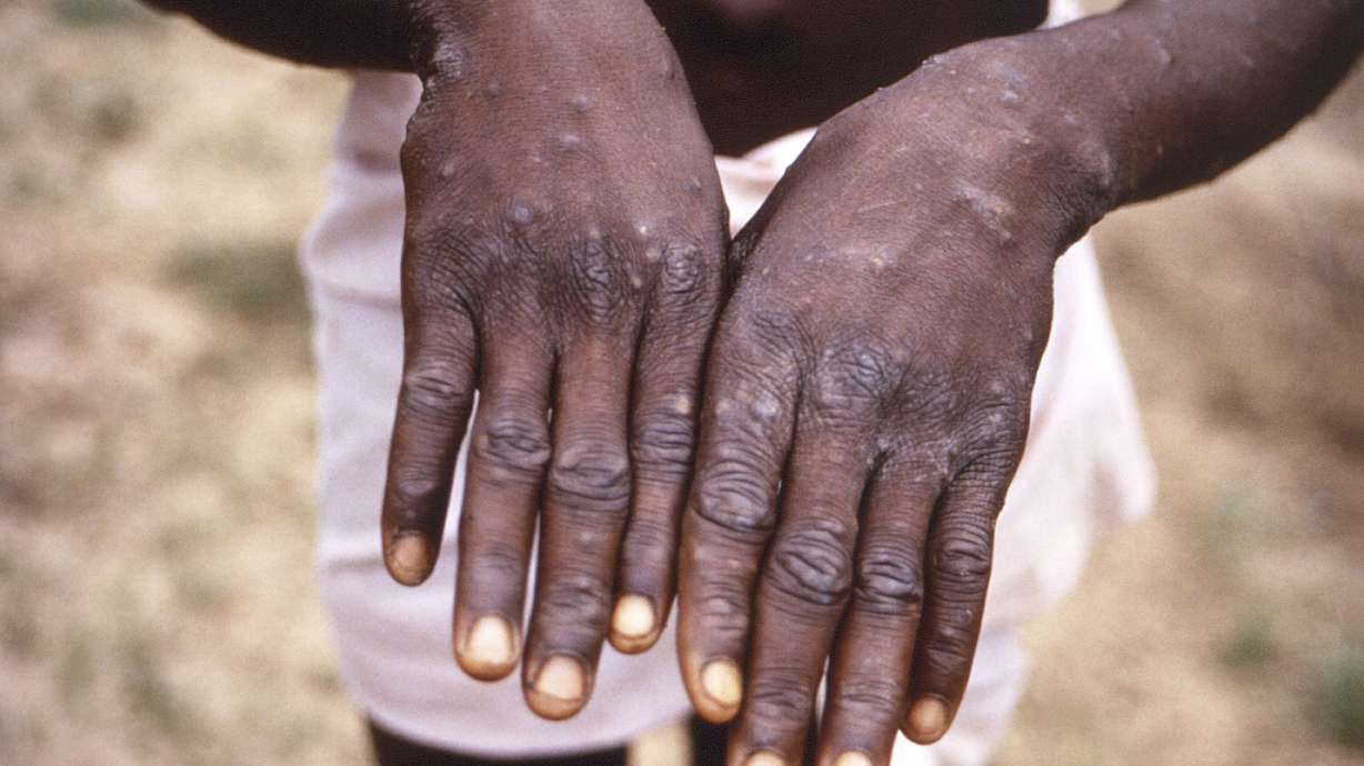 This 1997 image provided by the CDC during an investigation into an outbreak of monkeypox, which took place in the Democratic Republic of the Congo, formerly Zaire. The World Health Organization is creating a new vaccine-sharing mechanism to stop the spiraling outbreak of monkeypox in more than 30 countries beyond Africa.