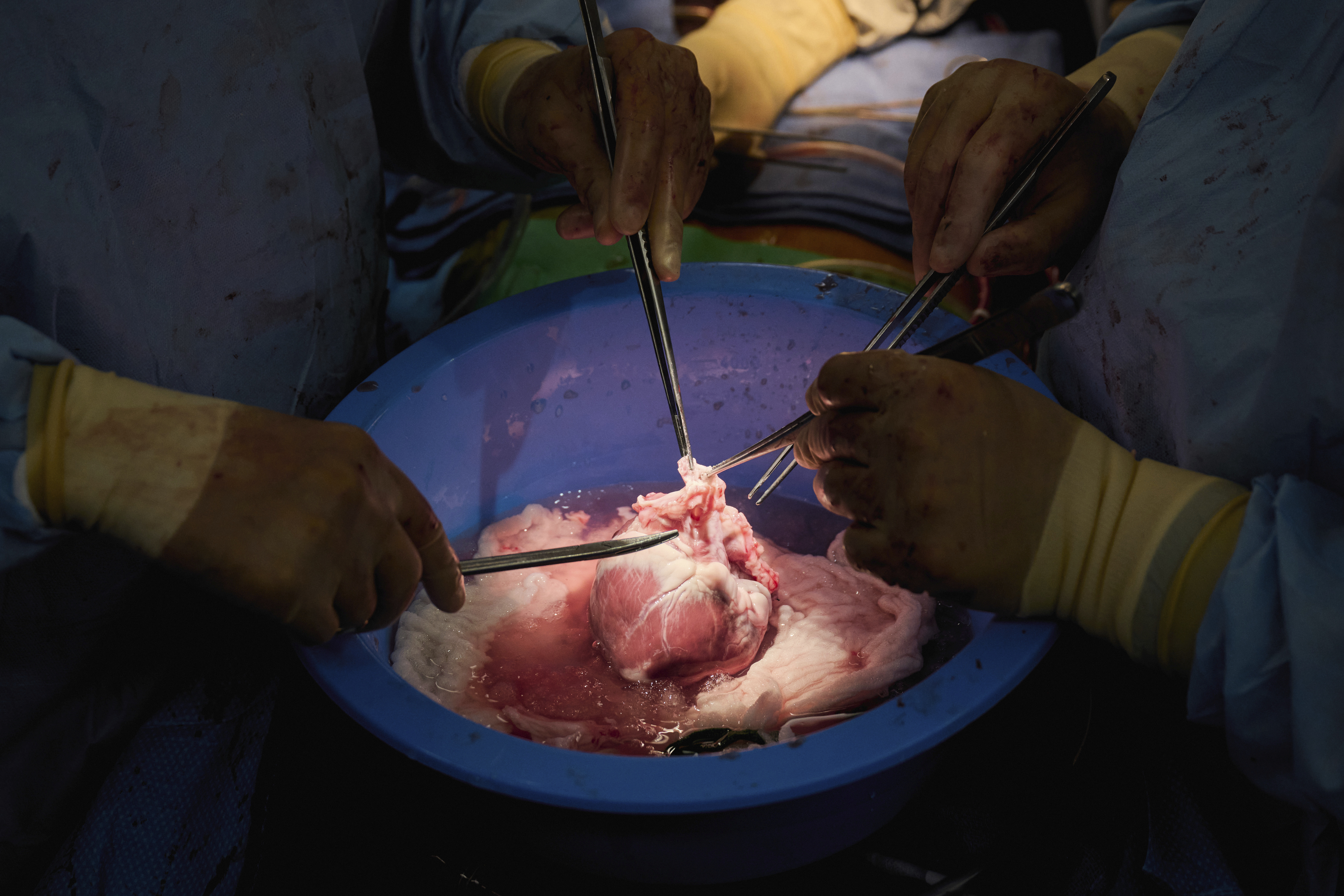 Surgeons prepare a genetically modified pig heart for transplant into a recently deceased donor at NYU Langone Health on July 6 in New York. Experiments are raising new hope that pigs might one day help fill a shortage of donated organs — at least, for people who need a new heart or kidney. 