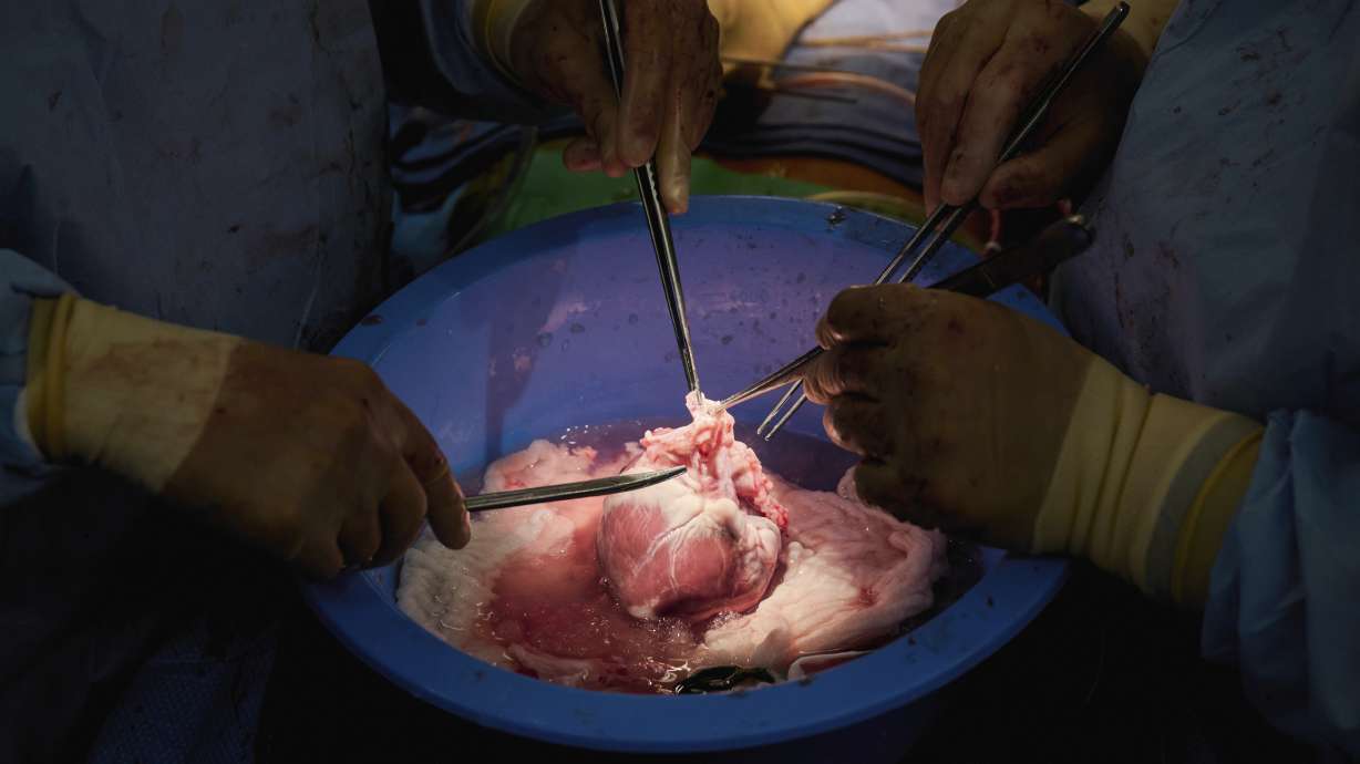Surgeons prepare a genetically modified pig heart for transplant into a recently deceased donor at NYU Langone Health on July 6 in New York. Experiments are raising new hope that pigs might one day help fill a shortage of donated organs — at least, for people who need a new heart or kidney.