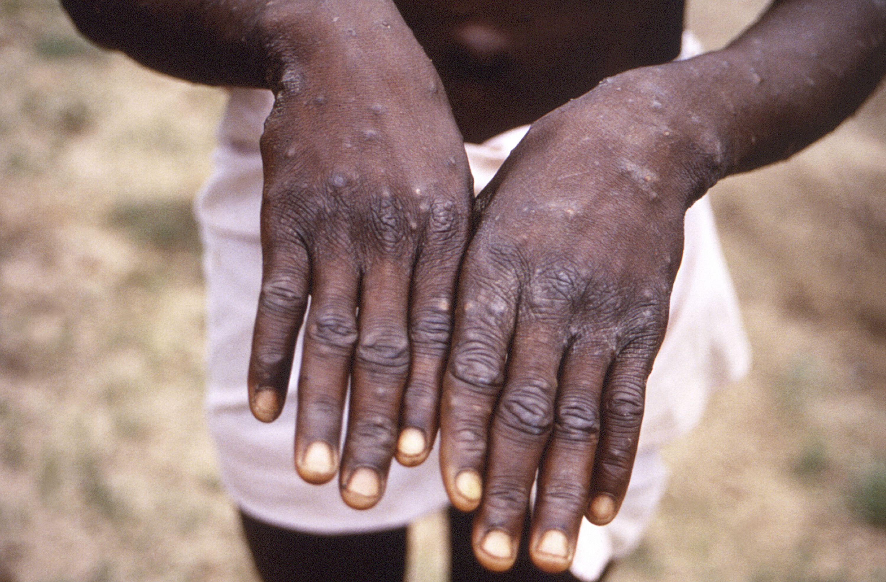 This 1997 image provided by the Centers for Disease Control and Prevention during an investigation into an outbreak of monkeypox, which took place in the Democratic Republic of the Congo, depicts the dorsal surfaces of the hands of a monkeypox case patient. The number of monkeypox cases in Utah continues to climb.