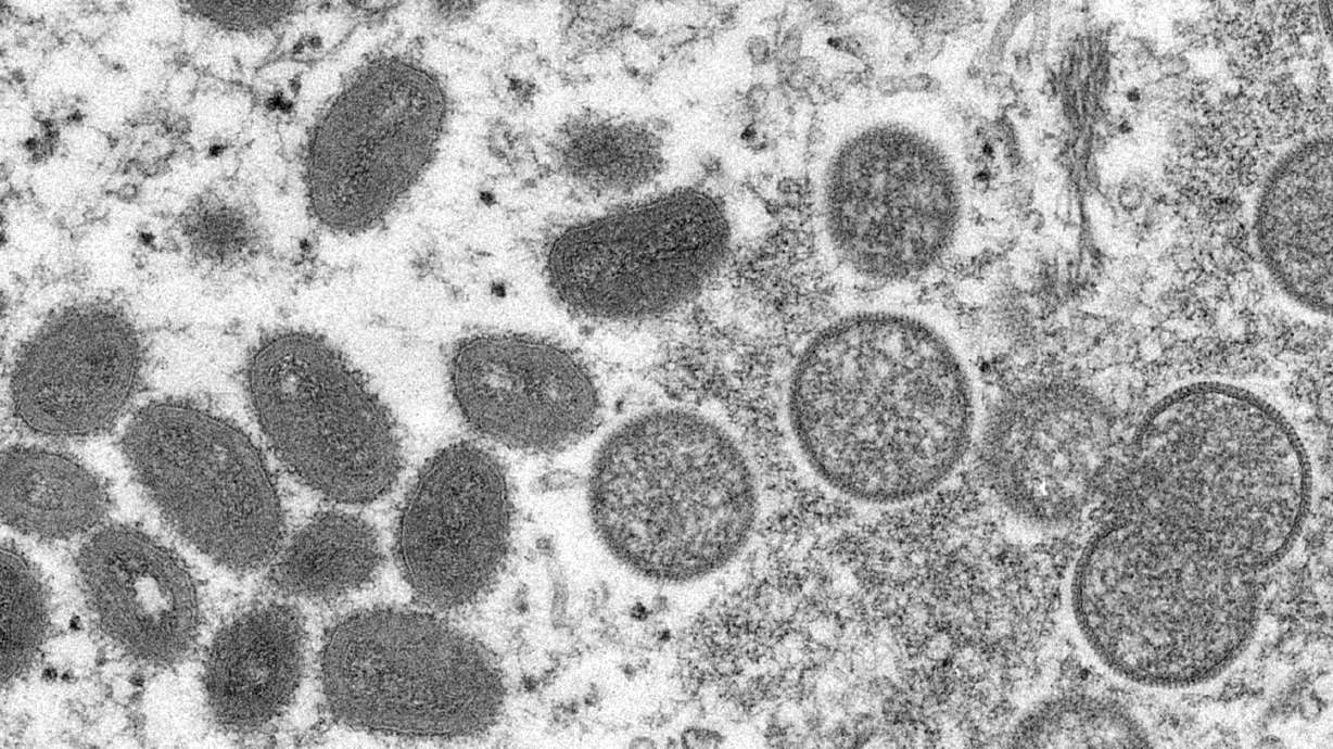 This 2003 electron microscope image made available by the U.S. Centers for Disease Control and Prevention shows mature, oval-shaped monkeypox virions, left, and spherical immature virions, right, obtained from a sample of human skin associated with the 2003 prairie dog outbreak. Two children have been diagnosed with monkeypox in the United States: a toddler in California and an infant who is not a U.S. resident, health officials said Friday.