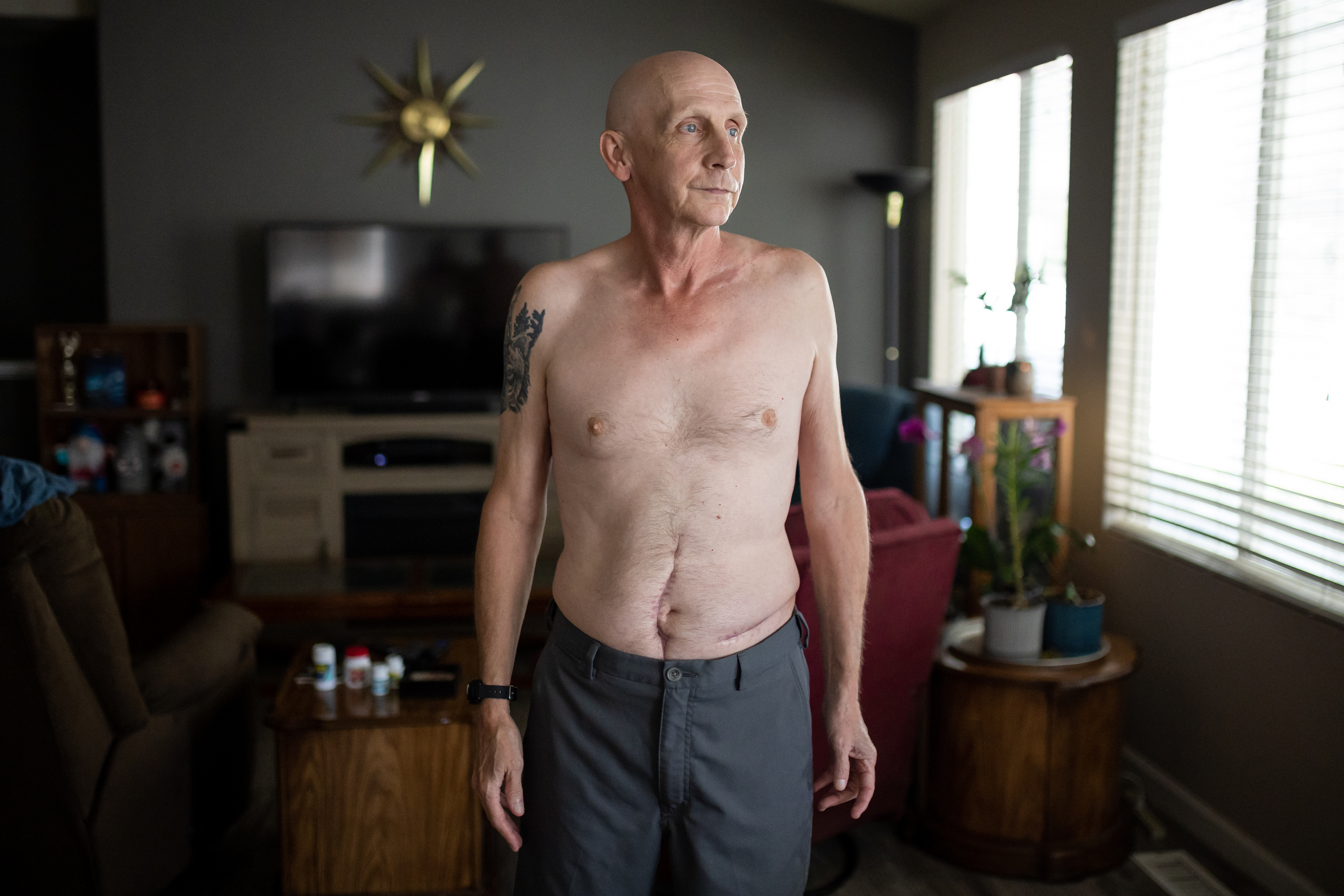 Shawn Moriarty, 60, shows the scars from injuries he sustained in a major car crash while he poses for a photo at his home in Magna on Tuesday. Moriarty was seriously injured in May after his car was struck head-on by one of two vehicles that were chasing each other during an altercation between their drivers, police say.