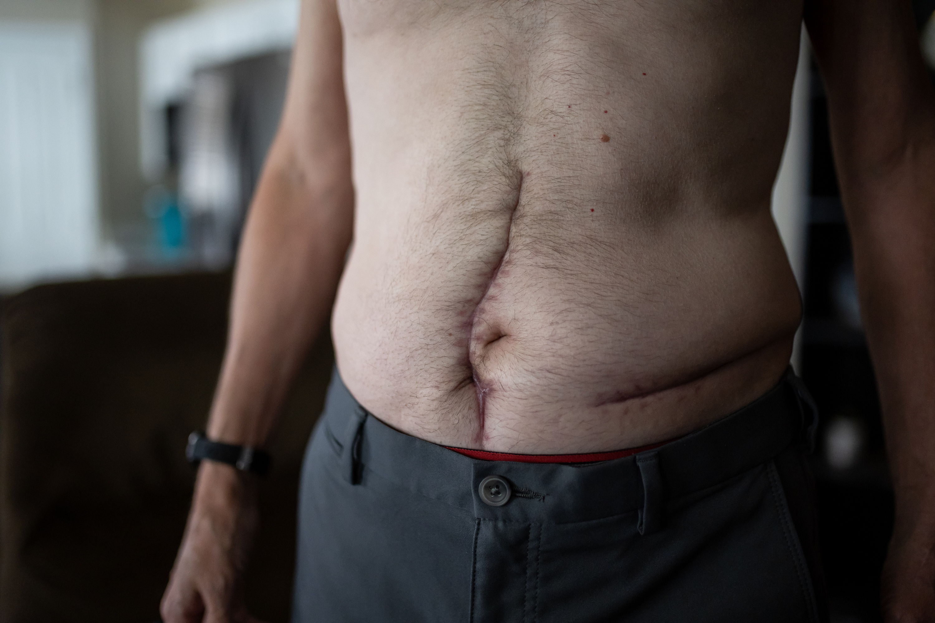 Shawn Moriarty, 60, shows scars he sustained in a major car crash while posing for photos at his home in Magna on Tuesday. Moriarty was seriously injured in May after his car was struck head-on by one of two vehicles that were chasing each other during an altercation between their drivers, police say.