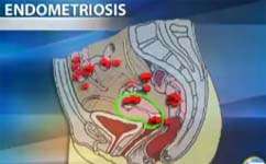 Evidence Indicates Endometriosis Could be Linked to Environment