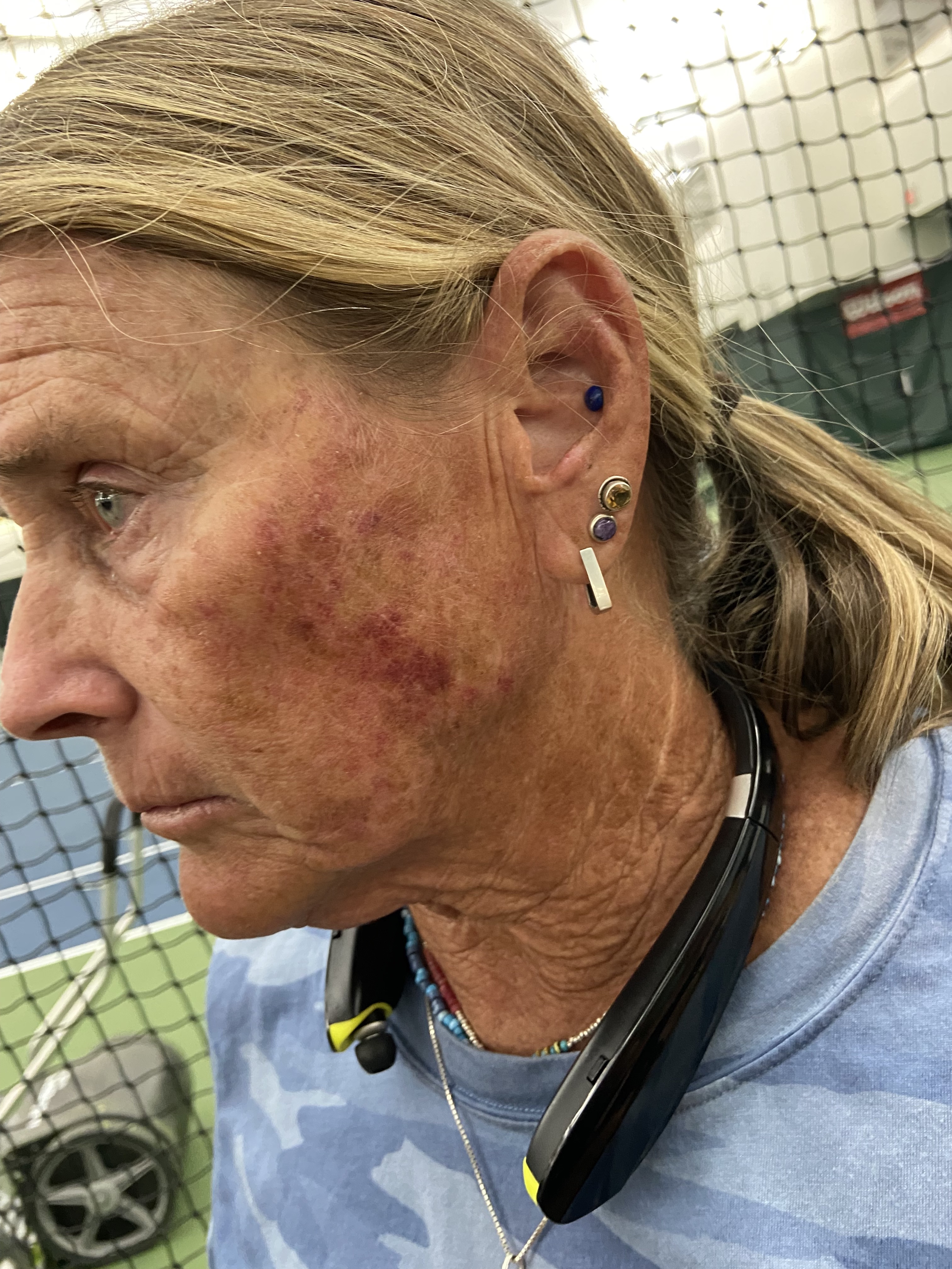 Park City High tennis coach Lani Wilcox displays injuries from an alleged assault by a student on Aug. 29. But Wilcox is now facing criminal charges accusing her of attacking the girl. 