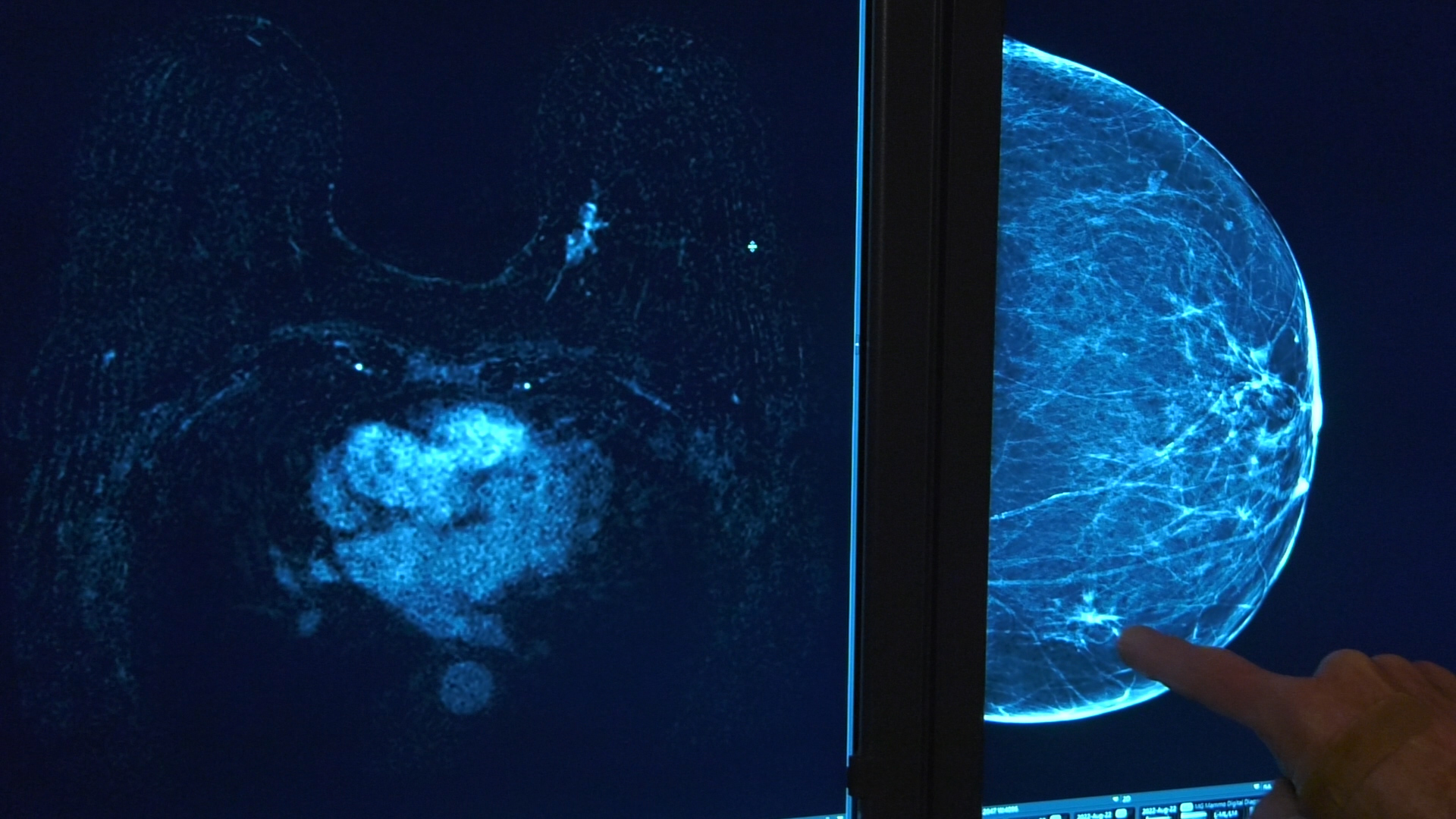 Intermountain Medical Center unveiled a new abbreviated MRI screening on Friday for women at high risk of breast cancer. The hyper-sensitive screening can detect up to twice as many cancers as a normal mammogram.