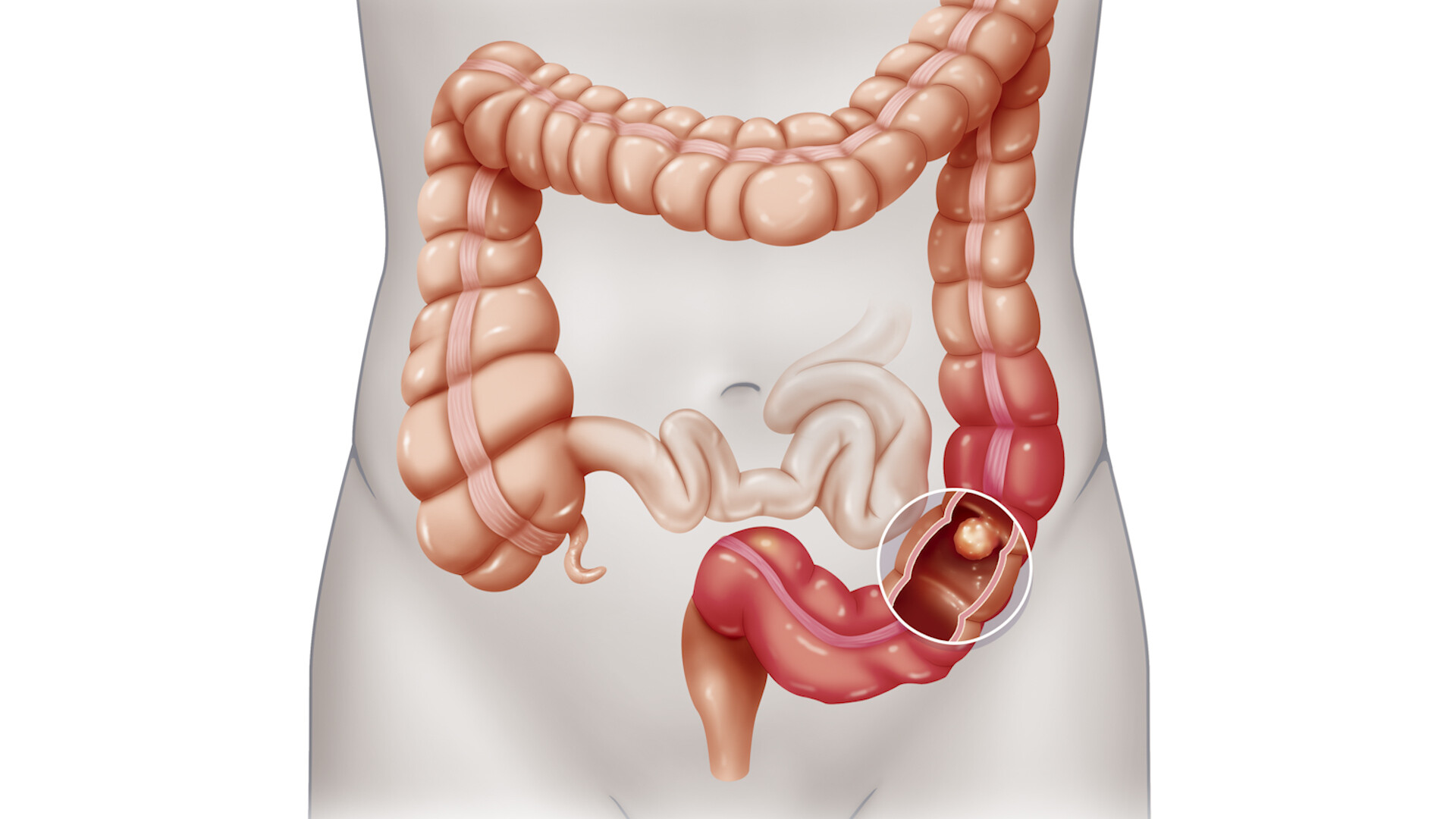 A new study on colonoscopies has complicated results, and it's left some people wondering whether they should have the procedure to screen for colon cancer.