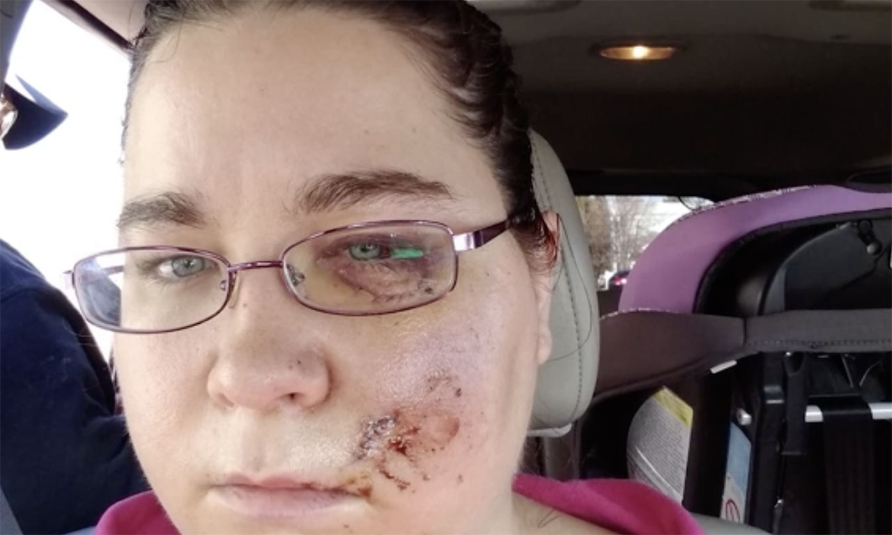 Brandy Jo Furniss was seriously injured when a rock from a passing truck went through the windshield of her car in 2019.