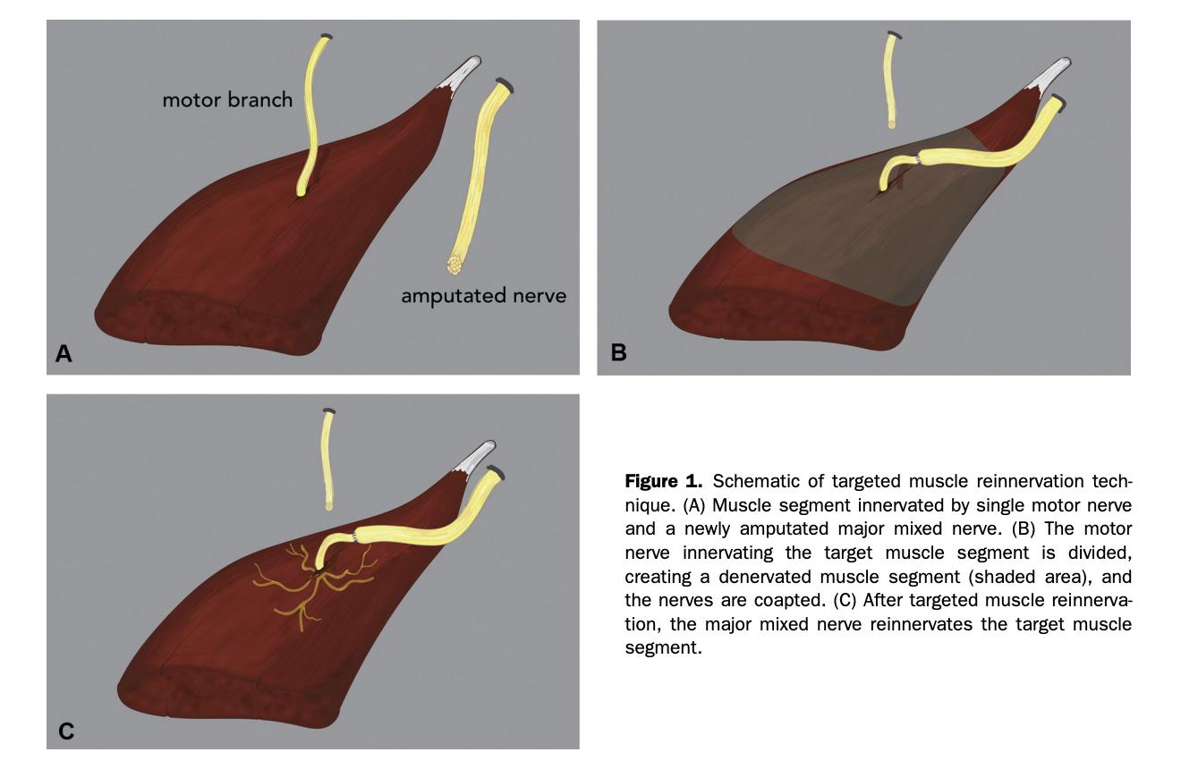 An illustration showing how targeted muscle reinnervation, or TMR, is performed following amputee surgery, to prevent phantom pain from the loss of a limb.