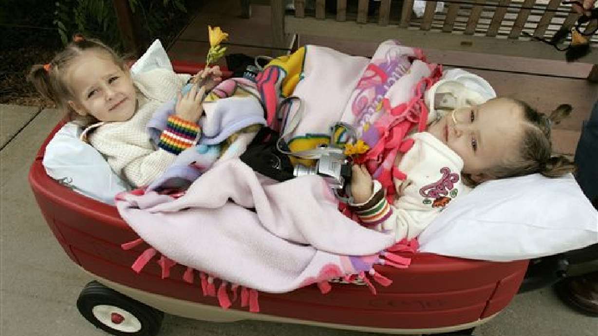 Herrin Twins Go Home, Six Weeks After Surgery