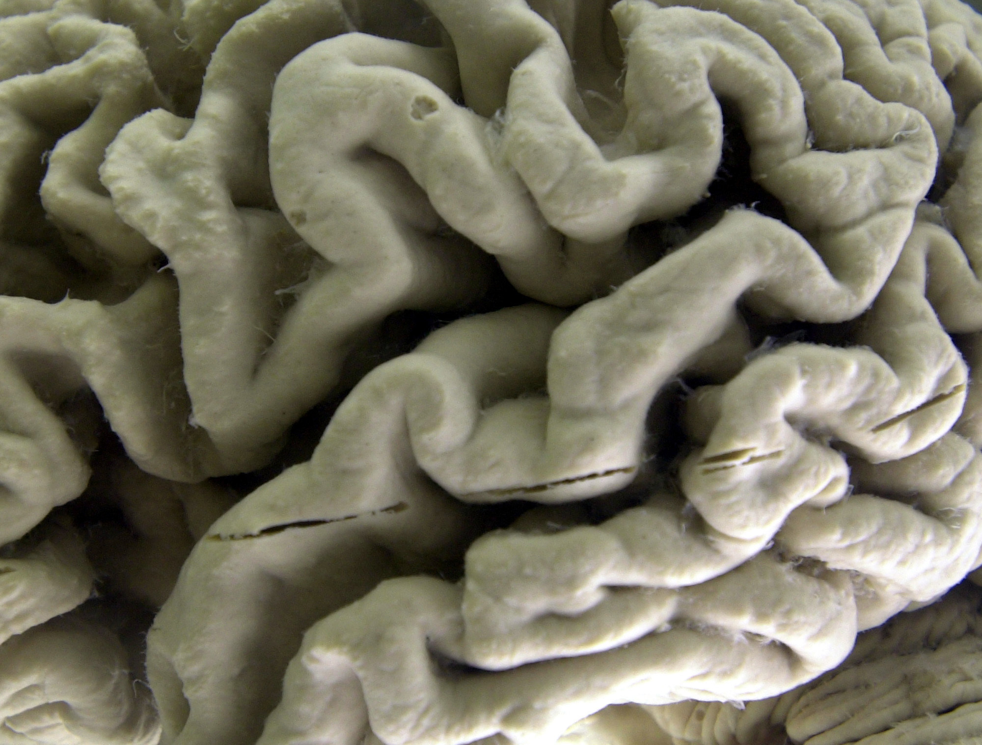 This Oct. 7, 2003, photo shows a closeup of a human brain affected by Alzheimer's disease, on display at the Museum of Neuroanatomy at the University at Buffalo in Buffalo, N.Y. An experimental Alzheimer’s drug modestly slowed the brain disease’s inevitable worsening, researchers reported Tuesday. 