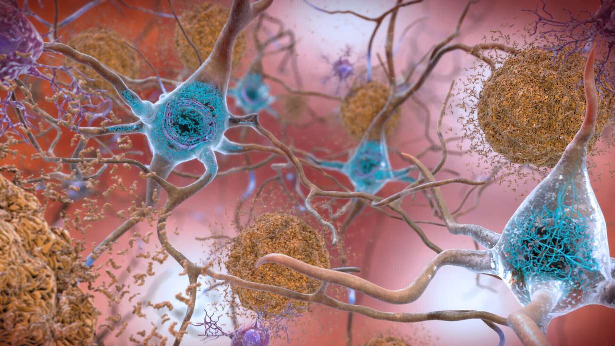 This illustration depicts cells in an Alzheimer’s affected brain, with abnormal levels of the beta-amyloid protein clumping together to form plaques, brown, that collect between neurons and disrupt cell function.
