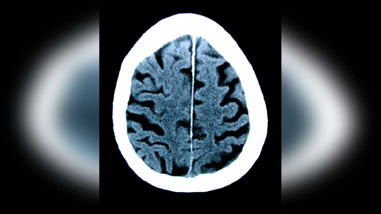 CT scan of an 84-year-old man with Alzheimer's disease. A new test can detect signs of Alzheimer's disease in a blood sample more accurately than previous tests, researchers say.