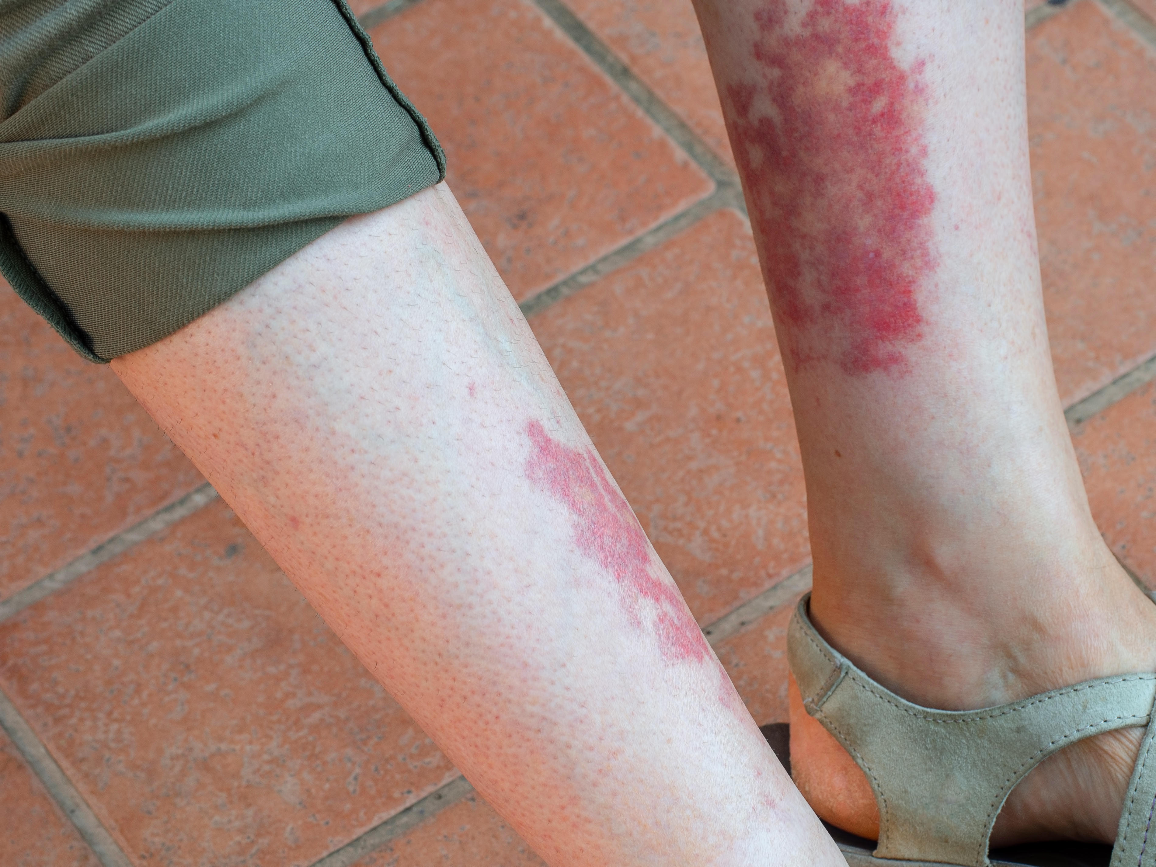 Leukocytoclastic vasculitis, an inflammatory reaction in the blood vessels, is shown. It's also known as golfer's, hiker's or exercise-induced-vasculitis, or Disney rash.