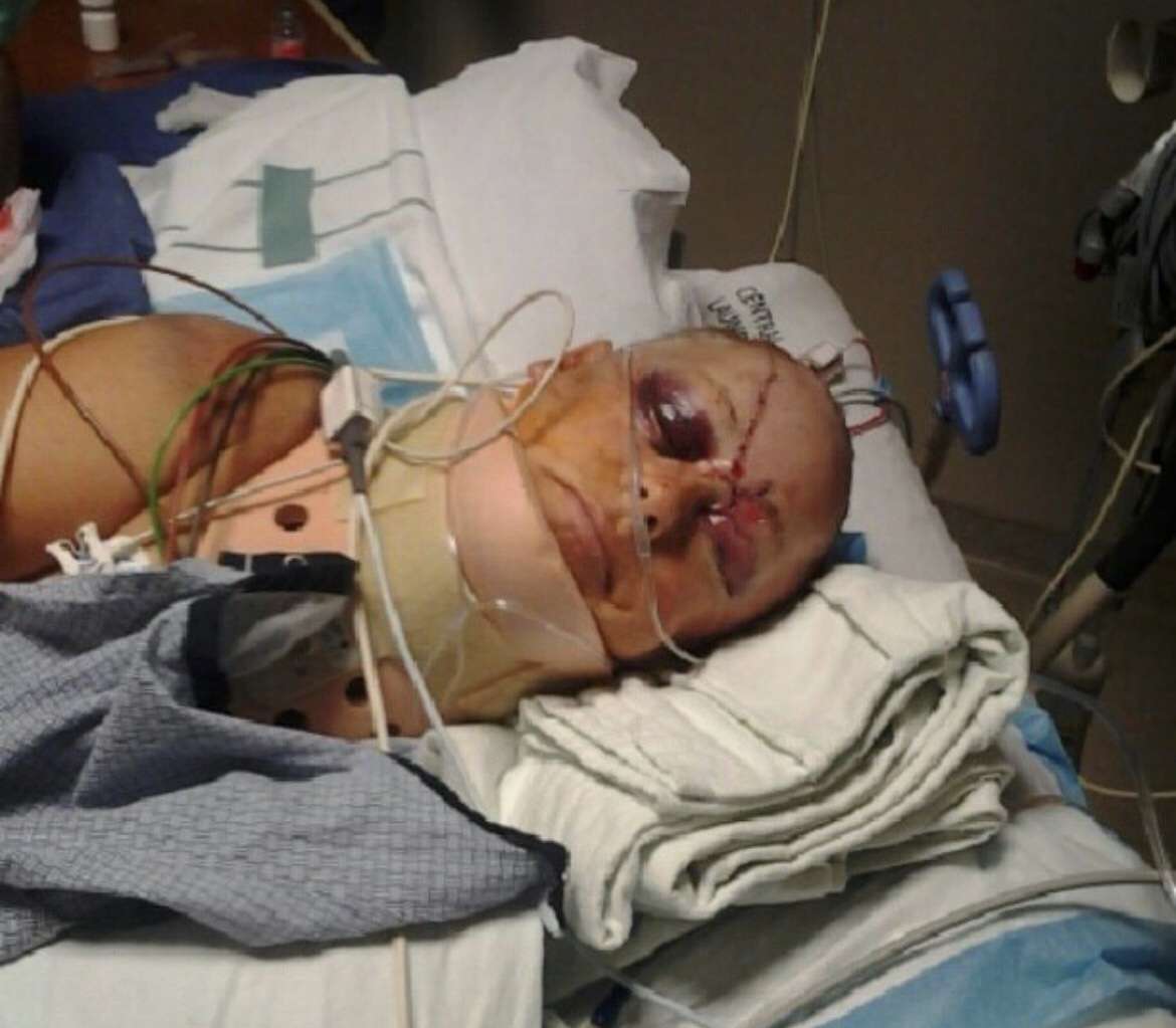 Leslee Henson receives 5,000 stitches and staples after being hit by a distracted driver on March 4, 2013. Distracted driving accidents are on the rise in Provo and Orem.