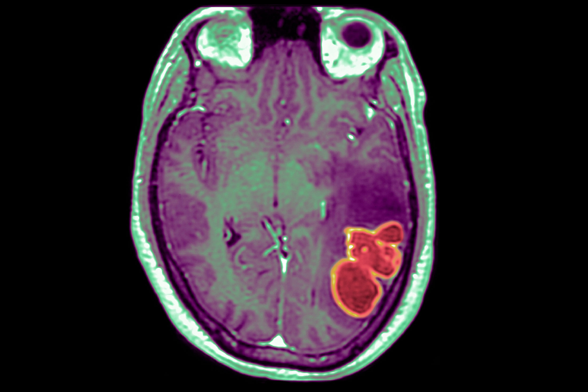 The CDC is investigating a cluster of rare and serious brain abscesses in kids in and around Las Vegas.