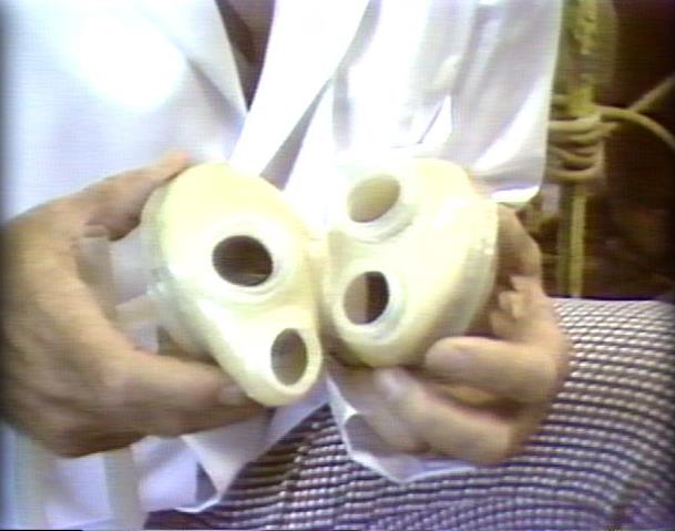 Symposium Held to Commemorate Artificial Heart Transplants