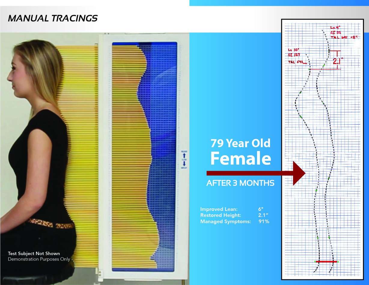 How a Utah woman restored 2 inches of height and relieved chronic back pain