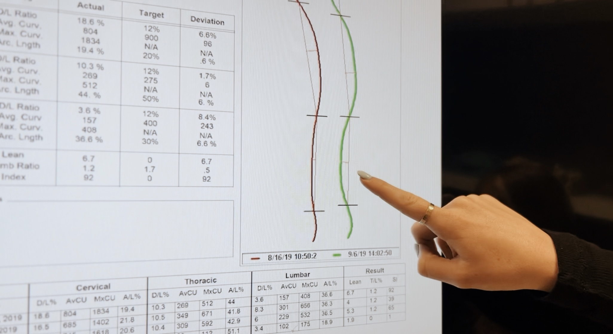 Here is the movie director’s spine shape before and after treatment spine. Initial change required only one month but ongoing success required sustained maintenance.
