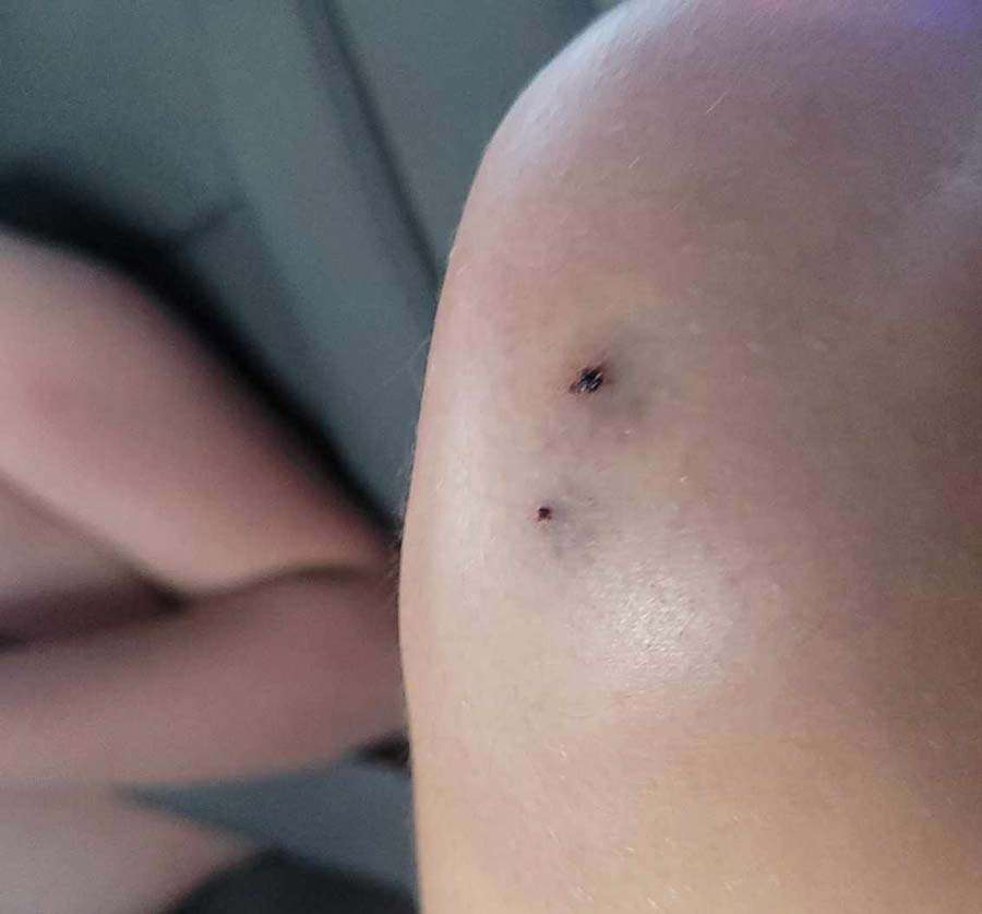 The initial bite is on Tasia Noyes’s knee. She is recovering at home after she was bitten by a rattlesnake while swimming.