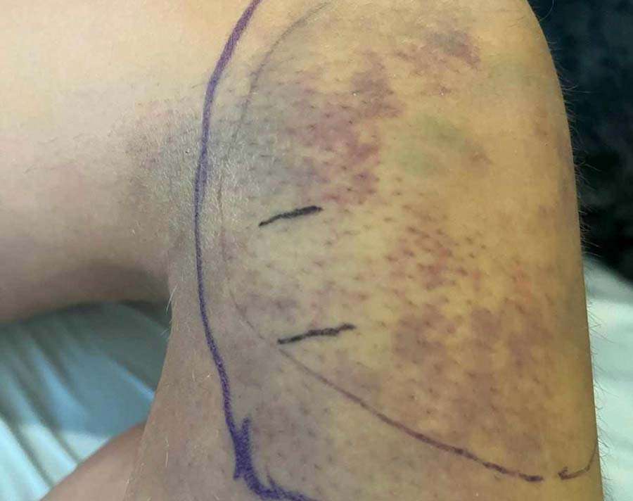 This is the bruising around the bite on Tasia Noyes's knee. She is recovering at home after being bitten by a rattlesnake while swimming.