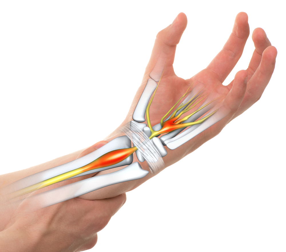 Elite Carpal Tunnel: Pioneering relief for carpal tunnel syndrome in Utah