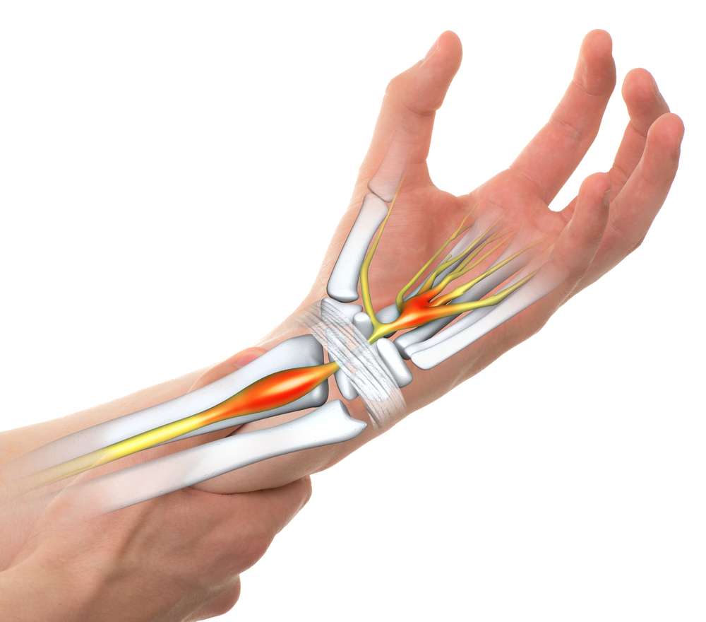 Elite Carpal Tunnel: Pioneering relief for carpal tunnel syndrome in Utah