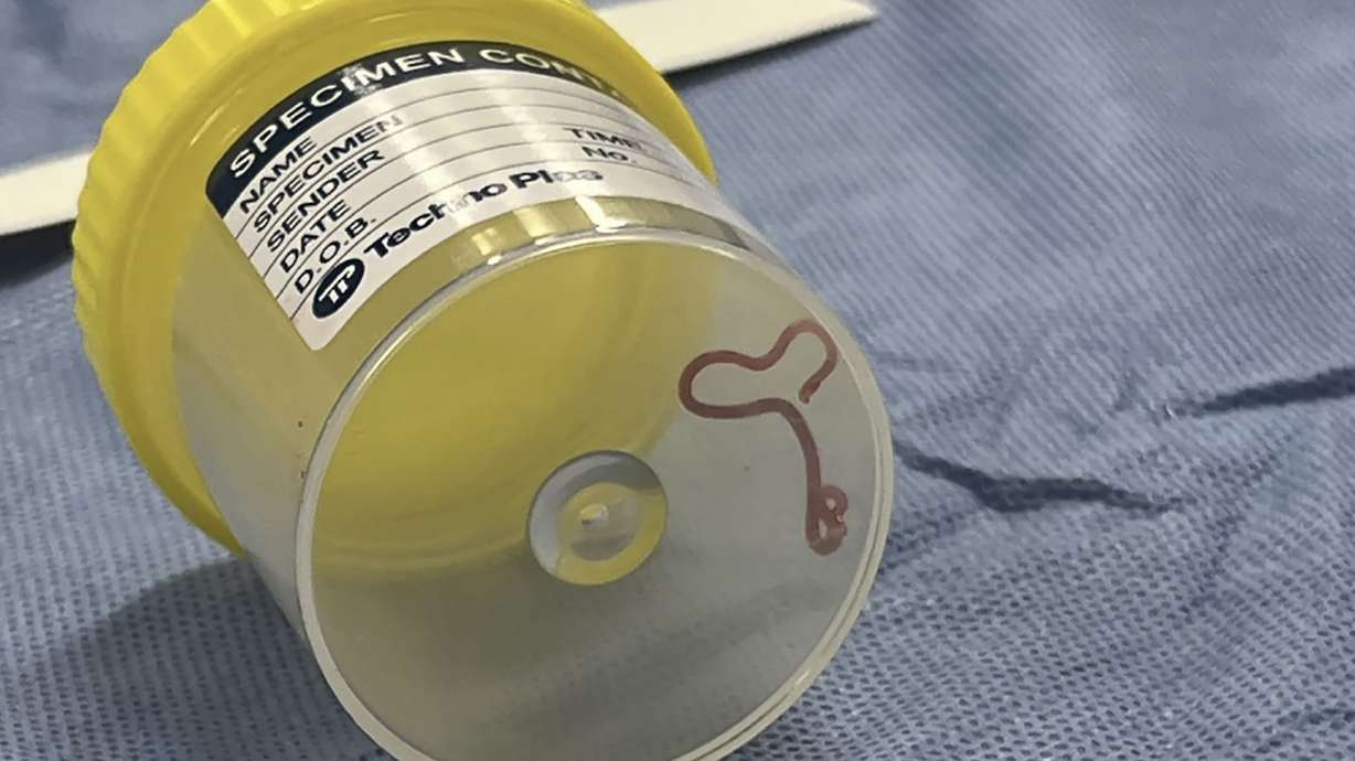 A parasite in a specimen jar is shown at a Canberra hospital in Australia. A neurosurgeon investigating a patient's mystery neurological symptoms plucked a 3-inch wriggling worm from her brain.