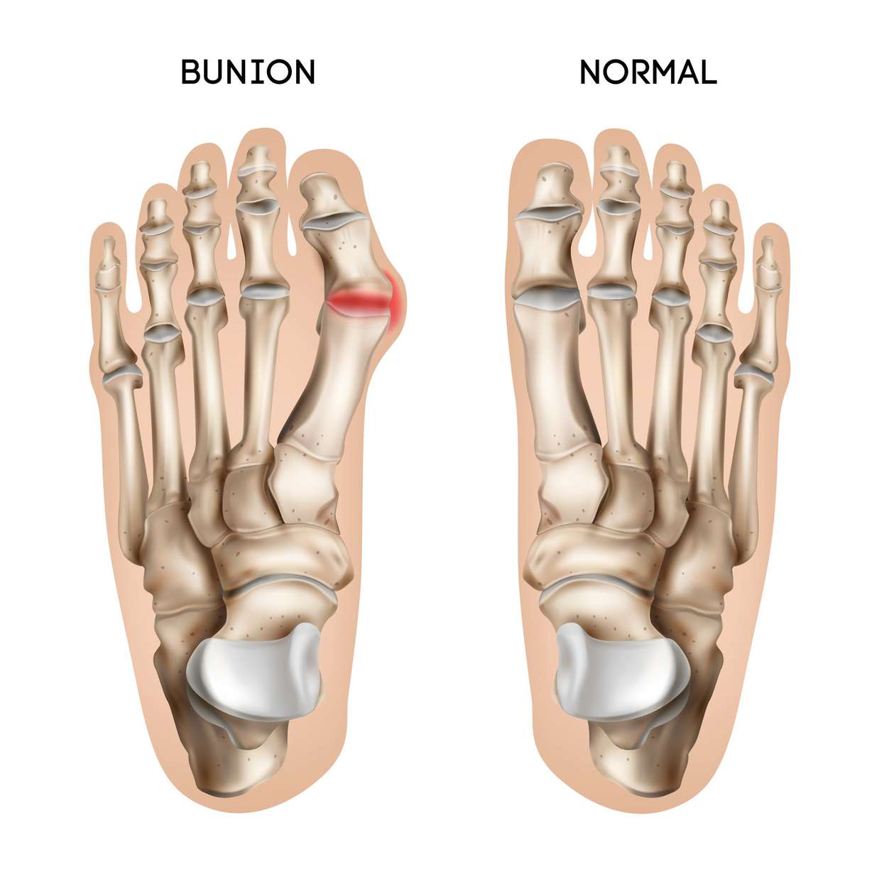 Pain-free feet possible with minimally invasive bunion surgery