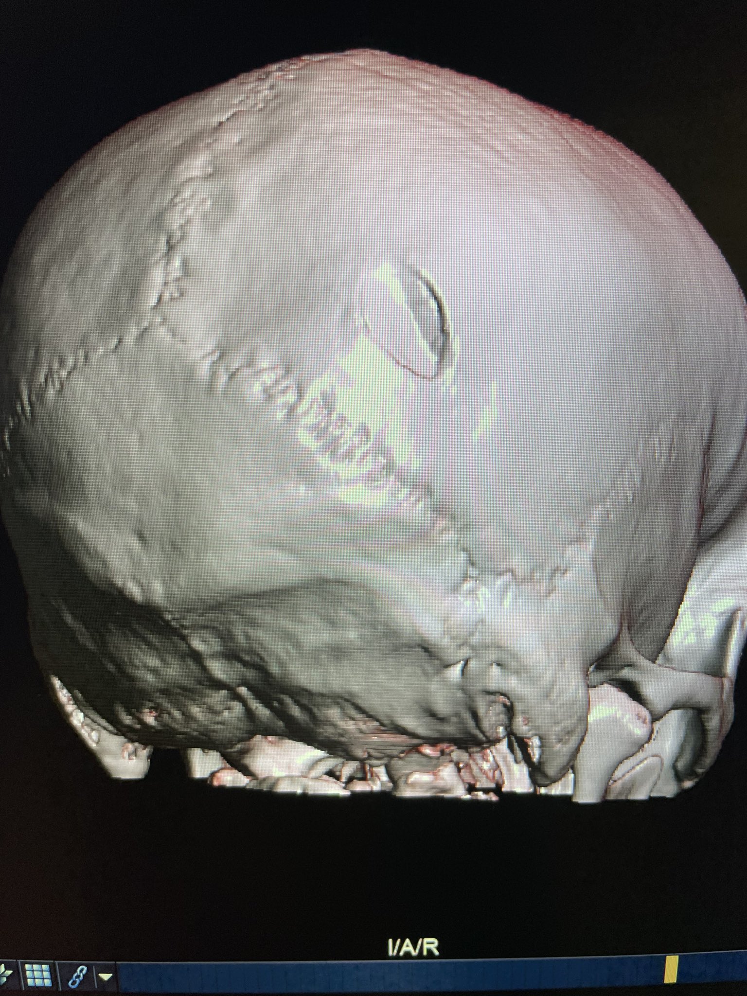 Utah man injured while helping fly American flag in Twin Falls, Idaho