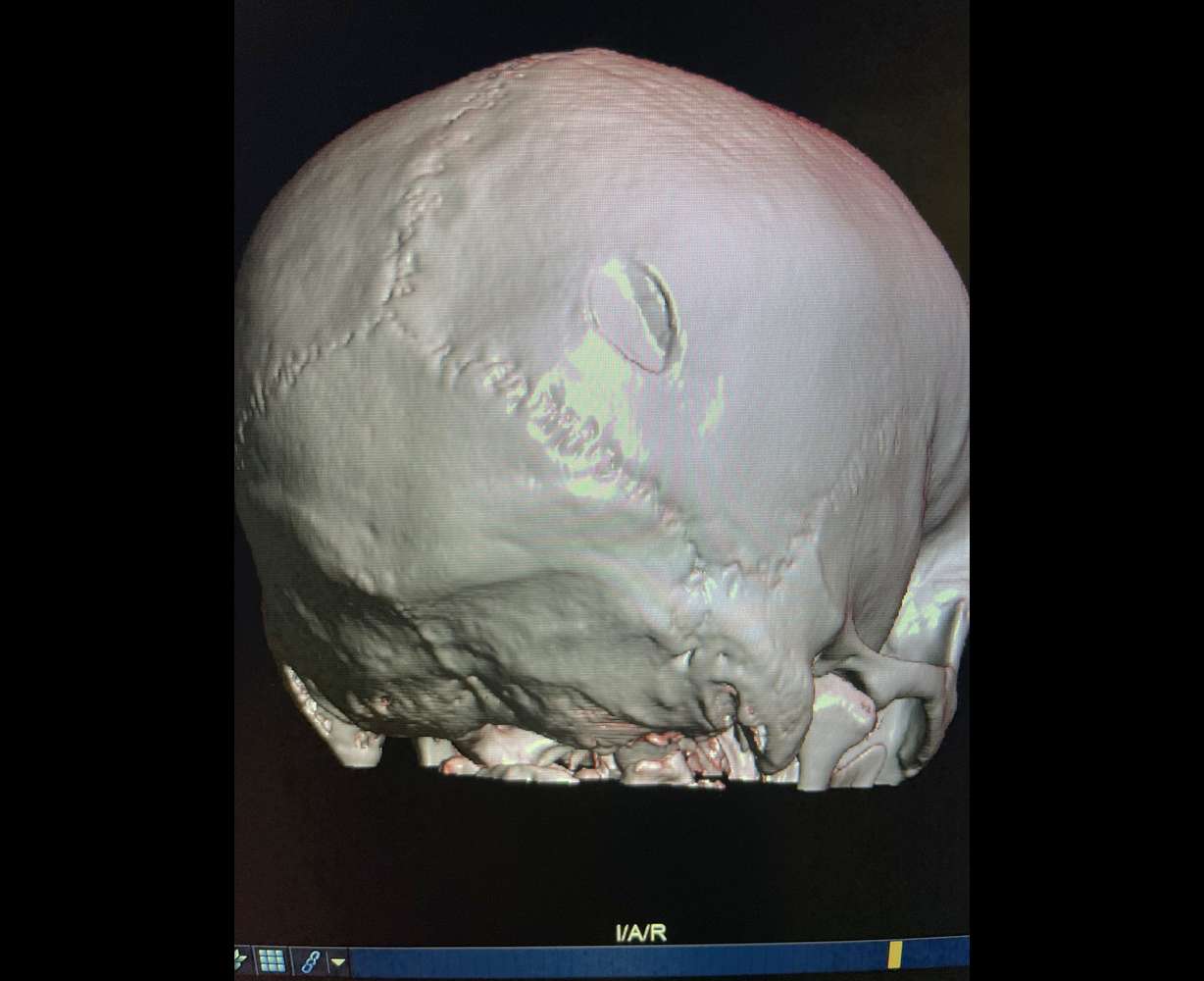 Utah man injured while helping fly American flag in Twin Falls, Idaho