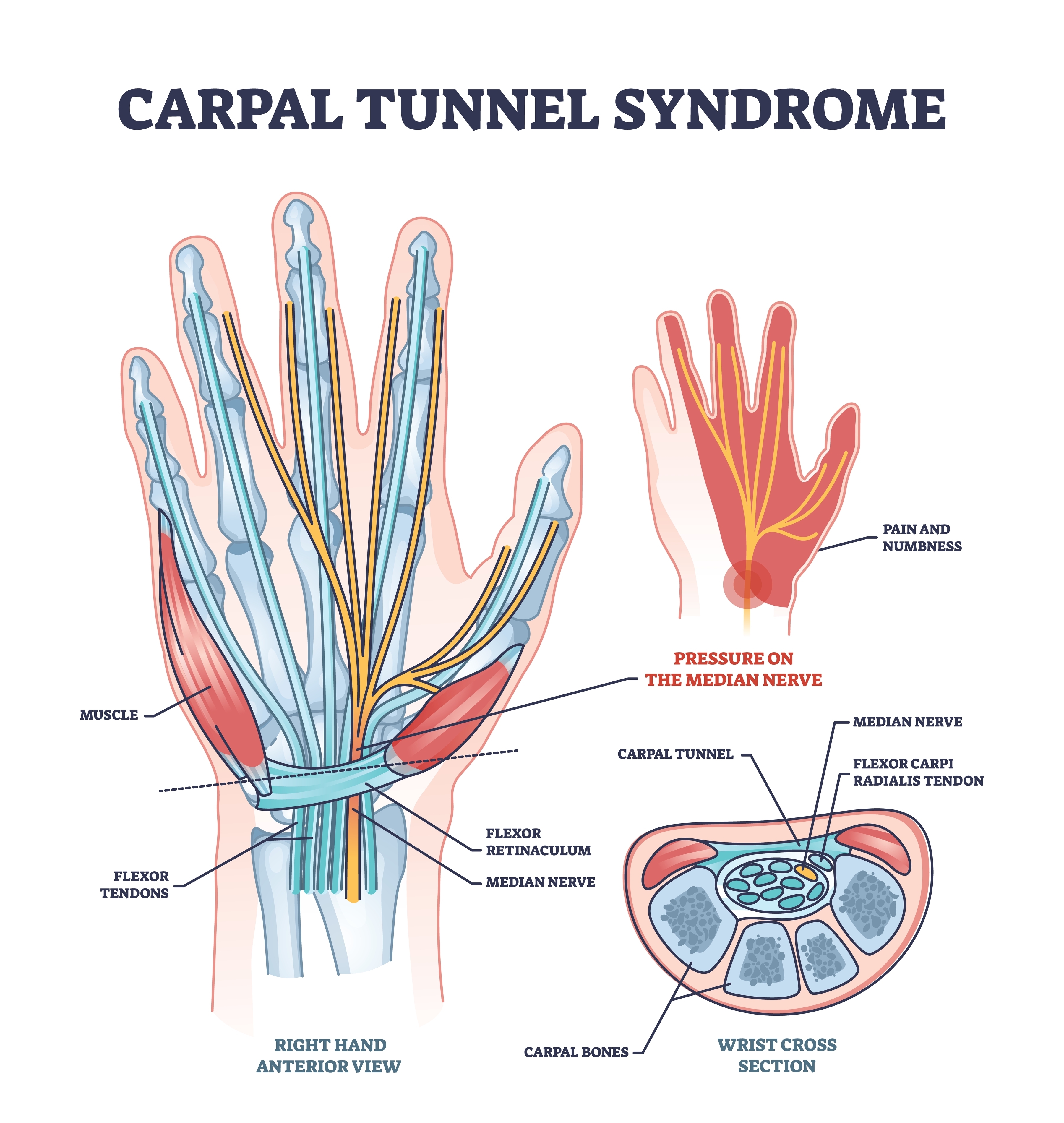 Sleep deprivation: is it torture or could it be Carpal Tunnel Syndrome?
