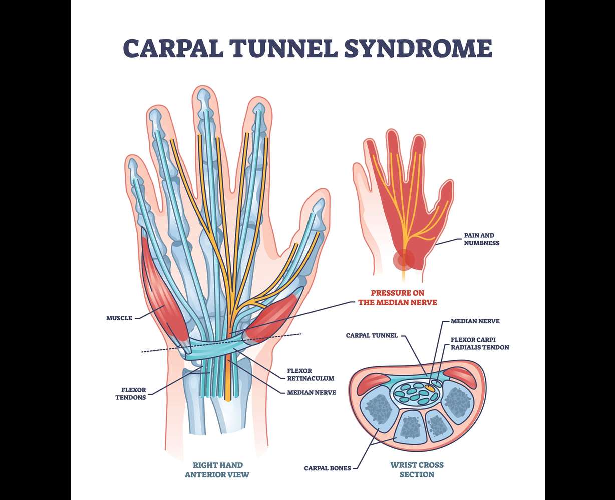 Sleep deprivation: is it torture or could it be Carpal Tunnel Syndrome?