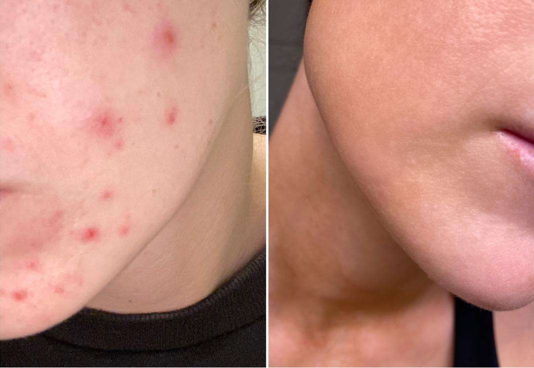 How you can reduce appearance of sunspots and aging in short treatments