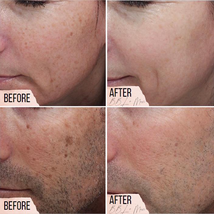 How you can reduce appearance of sunspots and aging in short treatments