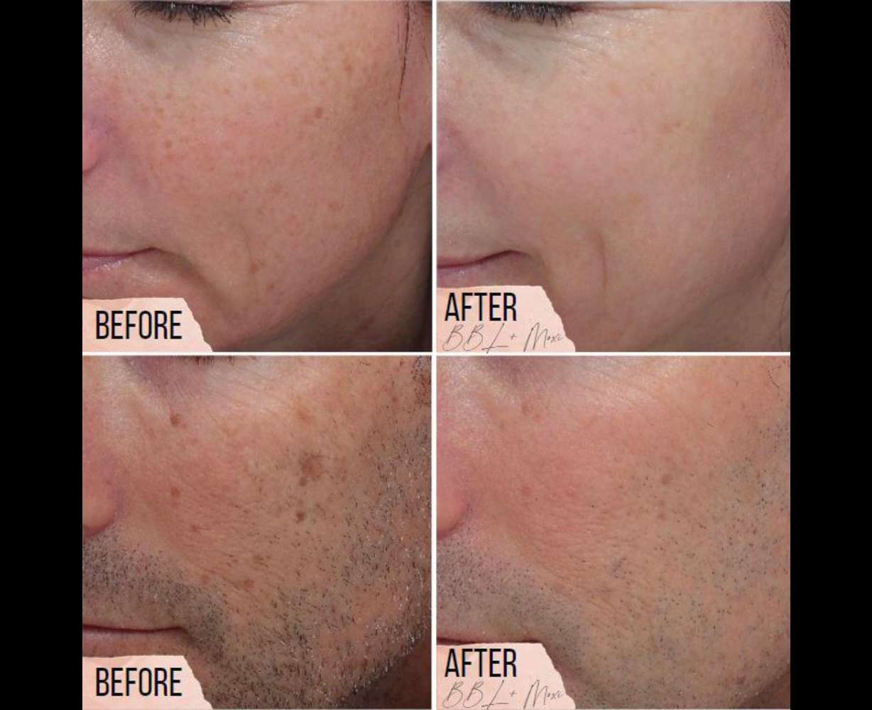 How you can reduce appearance of sunspots and aging in short treatments