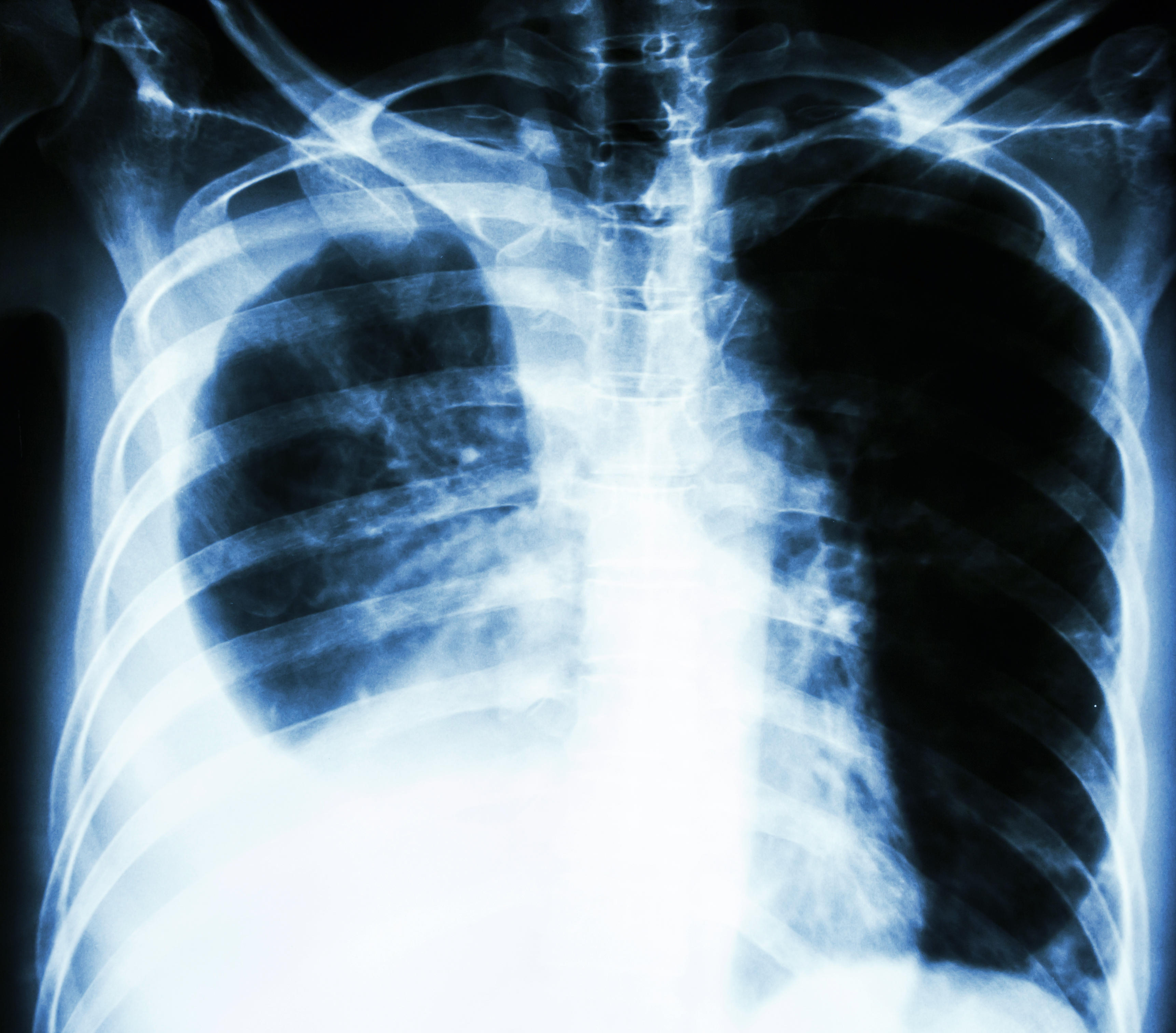 Nearly 5 million additional people are recommended to get screened for lung cancer under an updated guideline from the American Cancer Society.