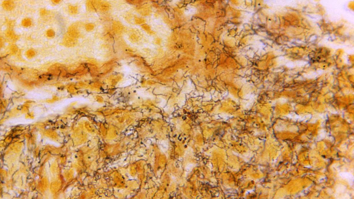 This 1966 microscope photo shows a tissue sample with the presence of numerous bacterium responsible for causing syphilis. On Tuesday U.S. health officials are calling for stepped-up prevention measures for the sexually transmitted disease.