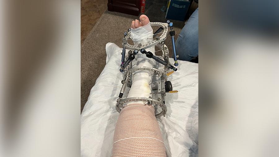 Debra Eaton’s foot after the surgery.