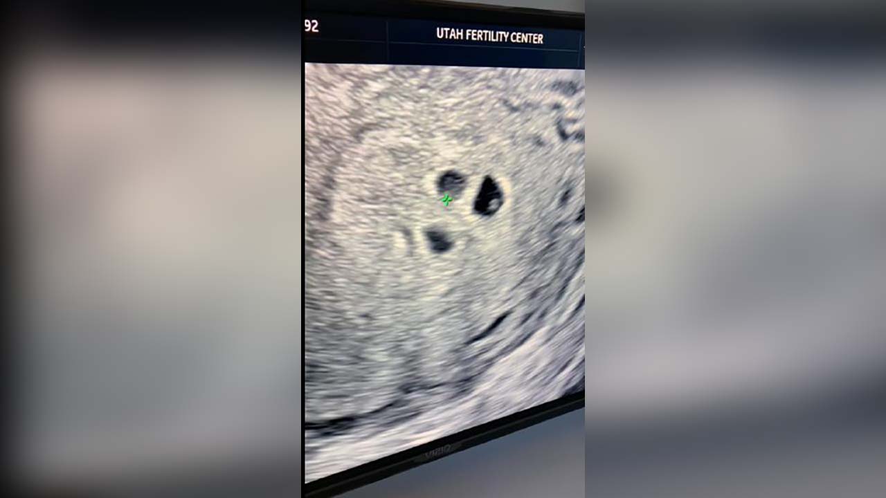 A photo of an ultrasound at Utah Fertility Center shows three embryos.