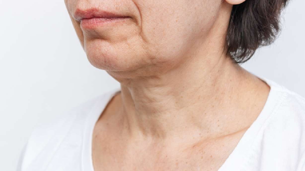 New treatment can reduce loose and saggy skin without surgery