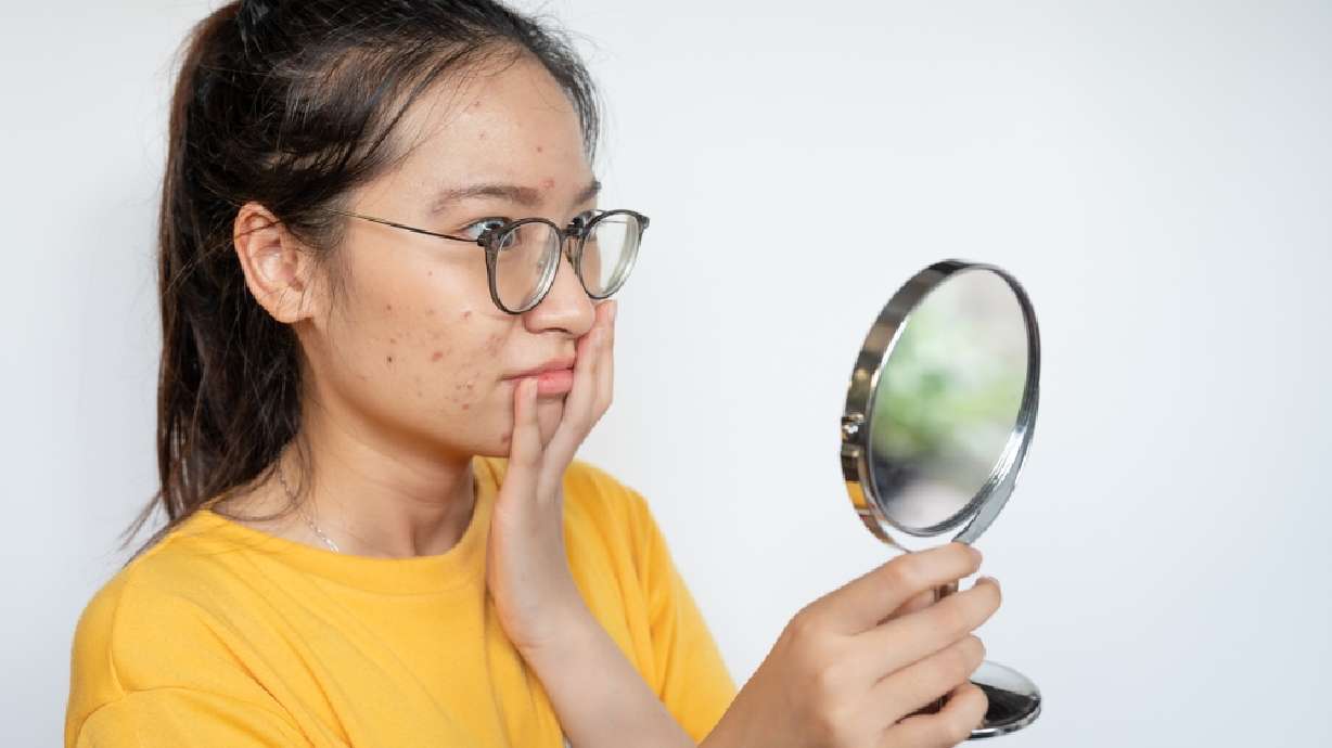 This treatment can help treat your teen's acne without medication