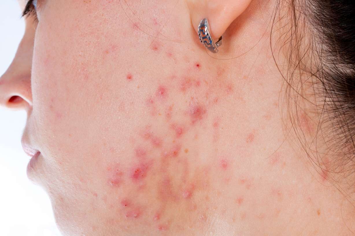 This treatment can help treat your teen's acne without medication